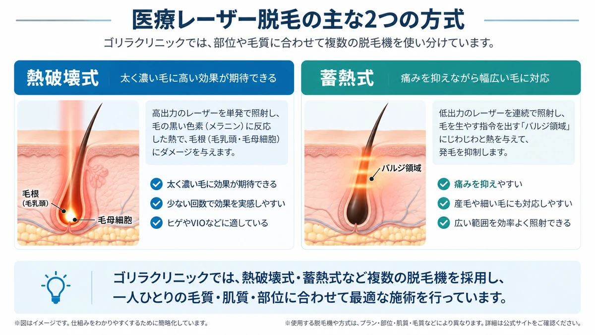熱破壊式と蓄熱式の医療レーザー脱毛を比較した図解