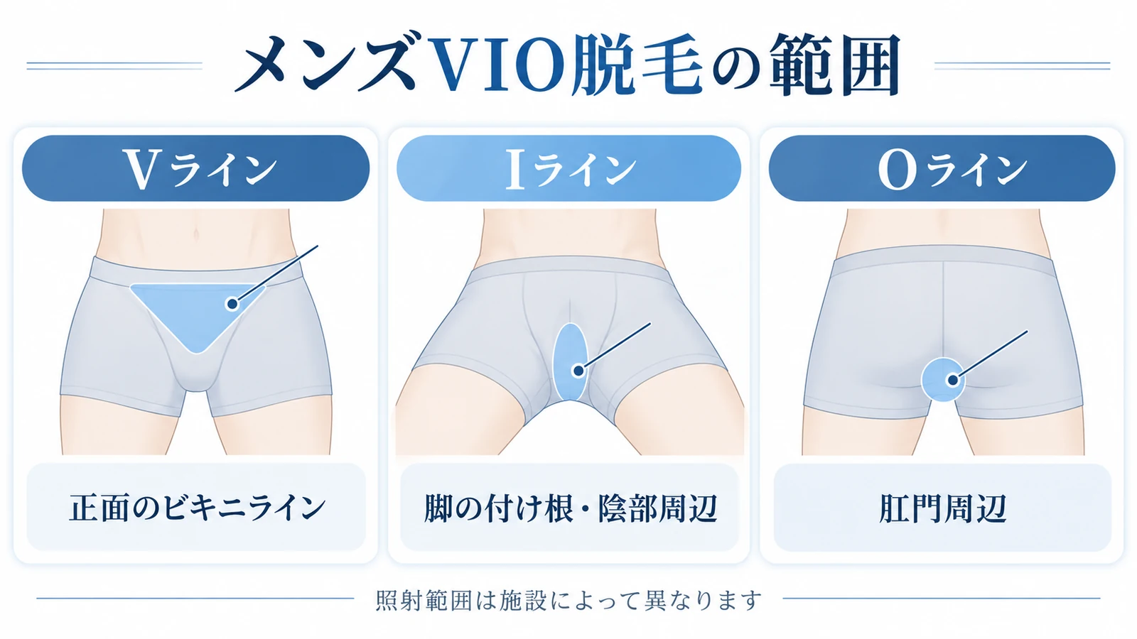 メンズVIO脱毛のVライン・Iライン・Oラインの範囲を示した図解